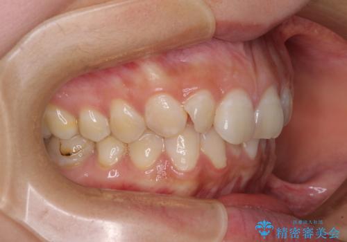 【モニター】隠れている下顎の前歯をインビザラインで改善の治療前