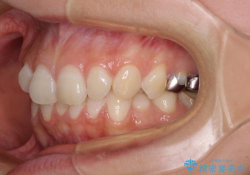 【モニター】隠れている下顎の前歯をインビザラインで改善の治療前