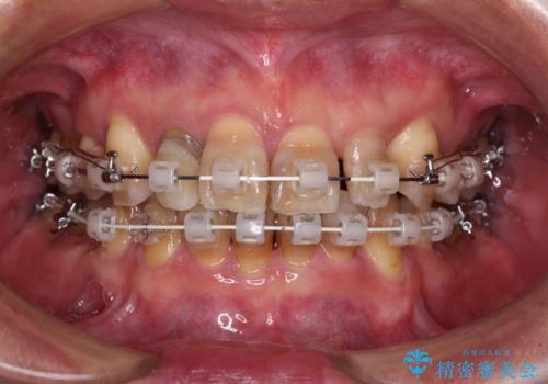 左右に骨格がずれて咬みにくい ワイヤー装置による抜歯矯正の治療中