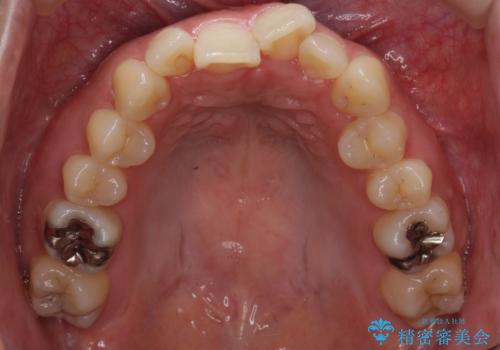 マウスピース矯正では難しい治療にも対応します 歯を抜かない矯正の治療前