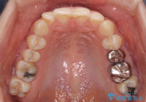 【モニター】隠れている下顎の前歯をインビザラインで改善の治療前