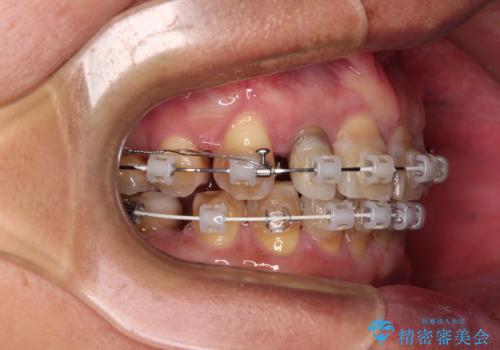 左右に骨格がずれて咬みにくい ワイヤー装置による抜歯矯正の治療中