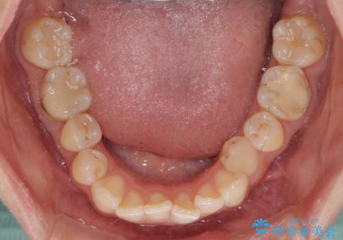 【モニター】隠れている下顎の前歯をインビザラインで改善の治療前