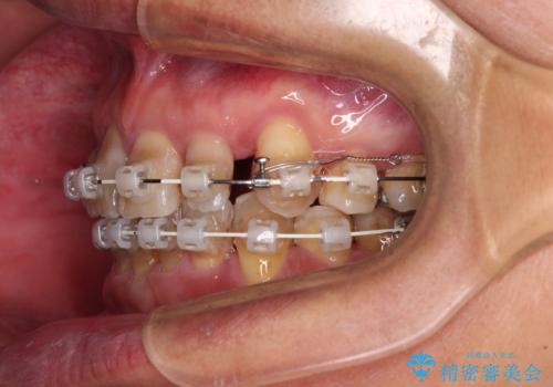 左右に骨格がずれて咬みにくい　ワイヤー装置による抜歯矯正の治療中