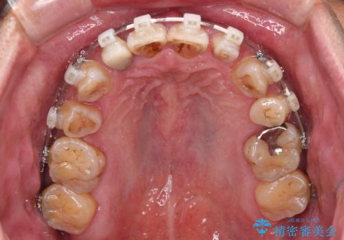 左右に骨格がずれて咬みにくい ワイヤー装置による抜歯矯正の治療中