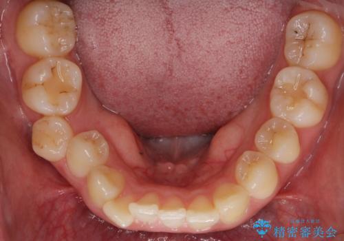 マウスピース矯正では難しい治療にも対応します　歯を抜かない矯正の治療前