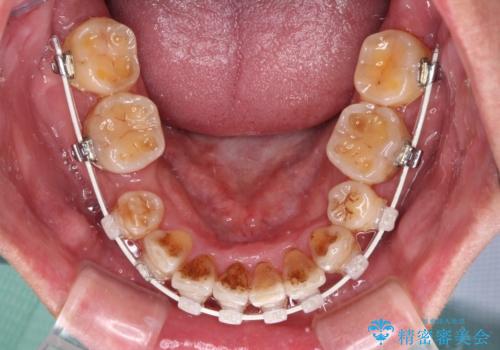 左右に骨格がずれて咬みにくい ワイヤー装置による抜歯矯正の治療中