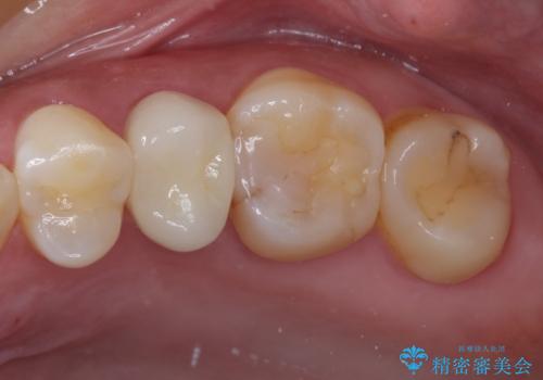 上下の歯が接触するだけで痛い　根管治療とオールセラミック治療の症例 治療後