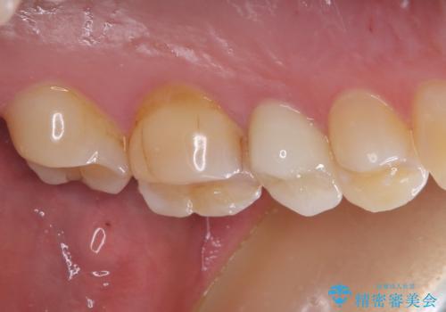 上下の歯が接触するだけで痛い 根管治療とオールセラミック治療の治療後