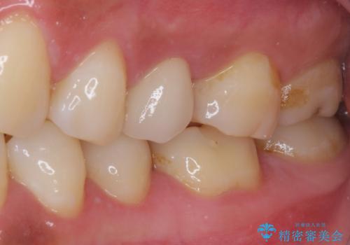 上下の歯が接触するだけで痛い 根管治療とオールセラミック治療の治療後