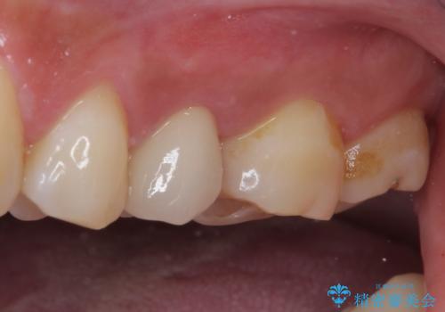 上下の歯が接触するだけで痛い 根管治療とオールセラミック治療の治療後