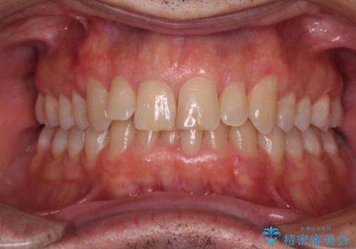 【モニター】前歯のデコボコを治したい インビザライン矯正治療の治療前