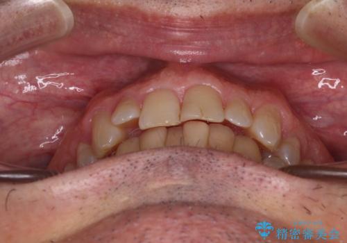 【モニター】前歯のデコボコを治したい インビザライン矯正治療の治療前