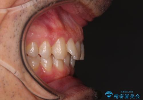 【モニター】前歯のデコボコを治したい インビザライン矯正治療の治療前