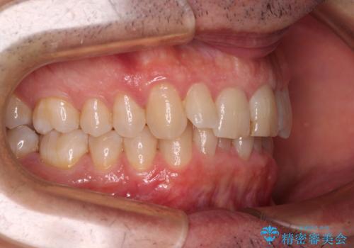 【モニター】前歯のデコボコを治したい インビザライン矯正治療の治療前