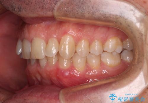 【モニター】前歯のデコボコを治したい インビザライン矯正治療の治療前