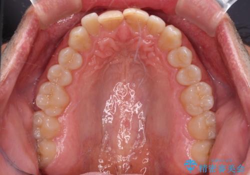 【モニター】前歯のデコボコを治したい インビザライン矯正治療の治療前