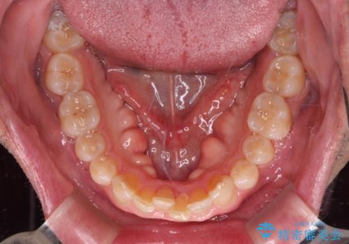 【モニター】前歯のデコボコを治したい インビザライン矯正治療の治療前