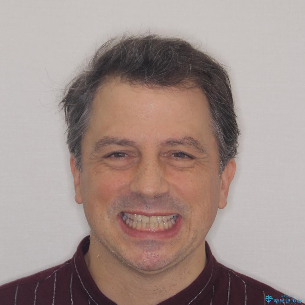 【モニター】前歯のデコボコを治したい インビザライン矯正治療の治療前(顔貌)