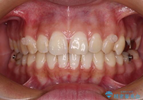 【モニター】隠れている下顎の前歯をインビザラインで改善の治療中