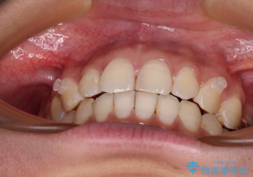 【モニター】隠れている下顎の前歯をインビザラインで改善の治療中