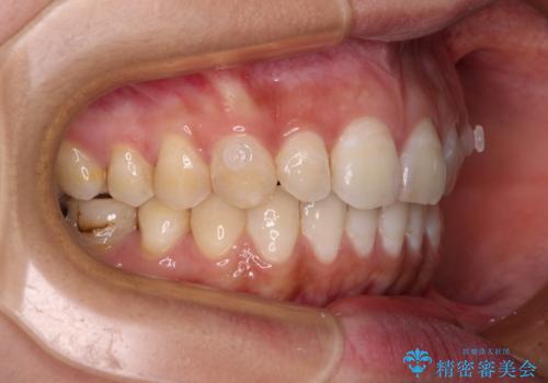 【モニター】隠れている下顎の前歯をインビザラインで改善の治療中