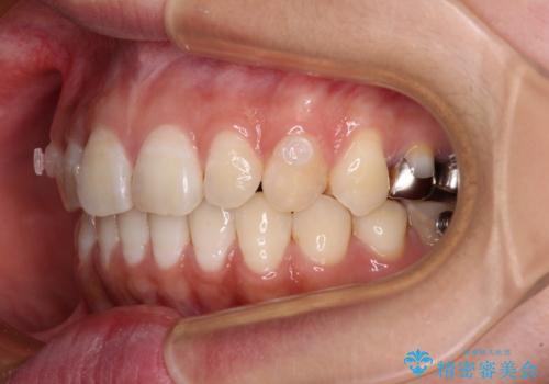 【モニター】隠れている下顎の前歯をインビザラインで改善の治療中