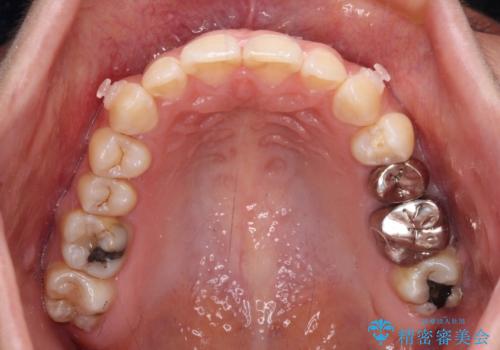 【モニター】隠れている下顎の前歯をインビザラインで改善の治療中