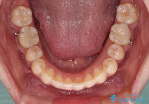 【モニター】隠れている下顎の前歯をインビザラインで改善の治療中