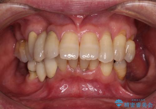 装着感の良い入れ歯を作りたい　金属床を使用した適合の良い部分床義歯の症例 治療前