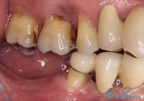 装着感の良い入れ歯を作りたい　金属床を使用した適合の良い部分床義歯の治療前