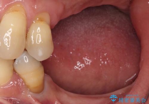 装着感の良い入れ歯を作りたい 金属床を使用した適合の良い部分床義歯の治療前