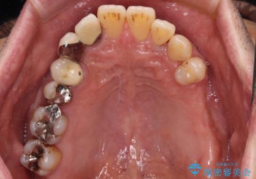 装着感の良い入れ歯を作りたい 金属床を使用した適合の良い部分床義歯の治療前