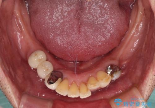 装着感の良い入れ歯を作りたい 金属床を使用した適合の良い部分床義歯の治療前
