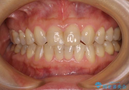つぎはぎだらけの前歯 オールセラミッククラウンで自然な歯にの治療前