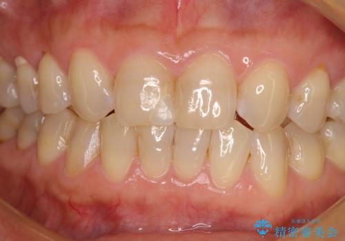 つぎはぎだらけの前歯 オールセラミッククラウンで自然な歯にの治療前