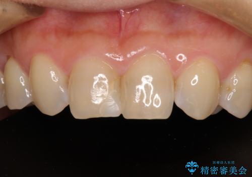 つぎはぎだらけの前歯 オールセラミッククラウンで自然な歯にの症例 治療前