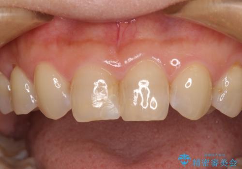 つぎはぎだらけの前歯 オールセラミッククラウンで自然な歯にの治療前