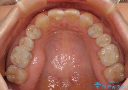つぎはぎだらけの前歯 オールセラミッククラウンで自然な歯にの治療前
