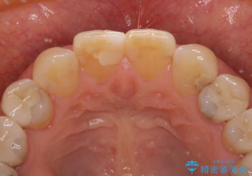 つぎはぎだらけの前歯 オールセラミッククラウンで自然な歯にの治療前