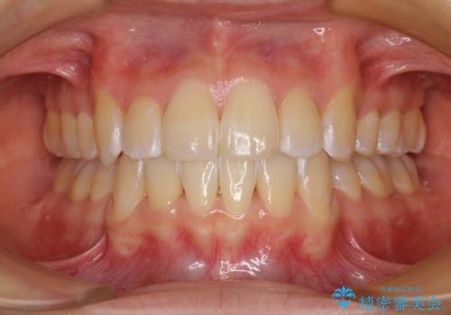 口が閉じにくい 目立たないワイヤー装置で口元をすっきりとの症例 治療後