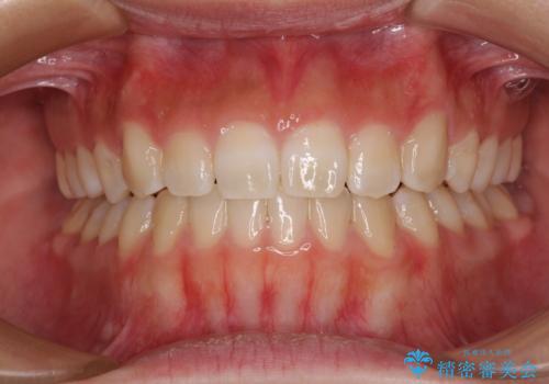 【モニター】上顎が狭い 急速拡大装置を用いたデコボコの解消の症例 治療後