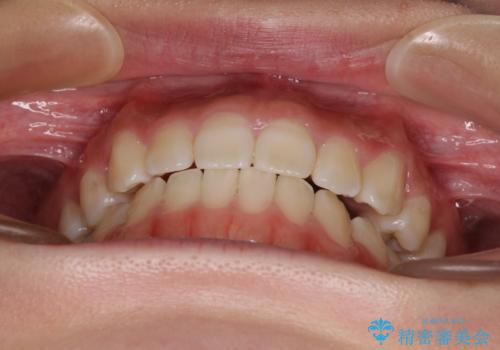 【モニター】上顎が狭い 急速拡大装置を用いたデコボコの解消の治療後
