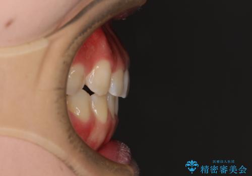 【モニター】上顎が狭い 急速拡大装置を用いたデコボコの解消の治療後