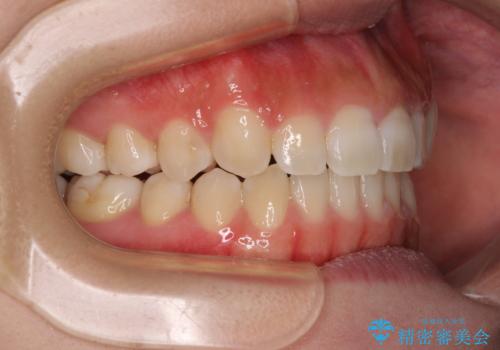 【モニター】上顎が狭い 急速拡大装置を用いたデコボコの解消の治療後