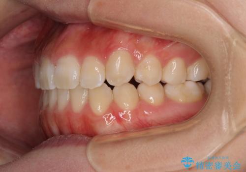 【モニター】上顎が狭い 急速拡大装置を用いたデコボコの解消の治療後