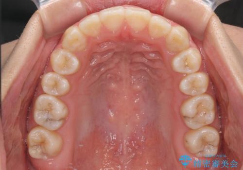 【モニター】上顎が狭い 急速拡大装置を用いたデコボコの解消の治療後