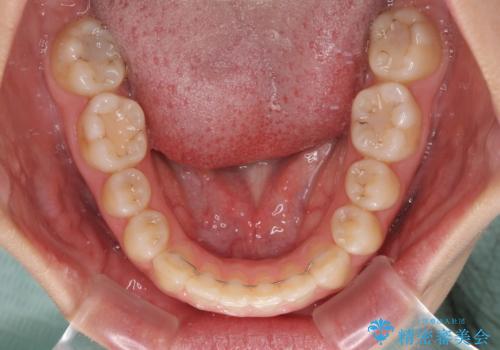 【モニター】上顎が狭い 急速拡大装置を用いたデコボコの解消の治療後