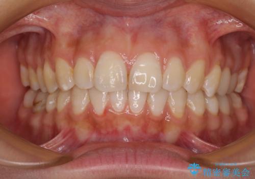 【モニター】隠れている下顎の前歯をインビザラインで改善の症例 治療後