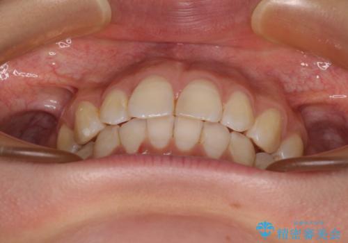 【モニター】隠れている下顎の前歯をインビザラインで改善の治療後